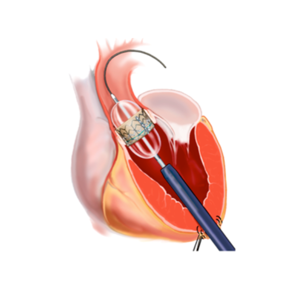 Avanços Tecnológicos no Tratamento Transcateter das Valvulopatias