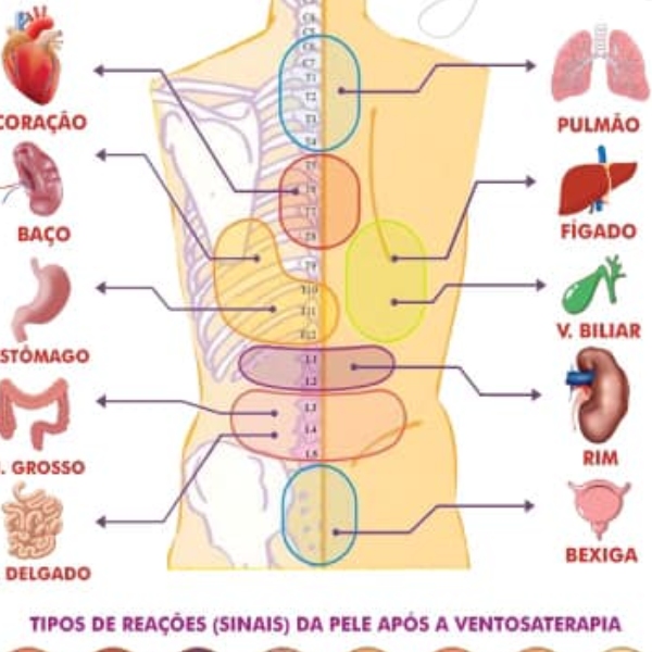 Histórico sobre Ventosaterapia e teoria sobre a Terapia 