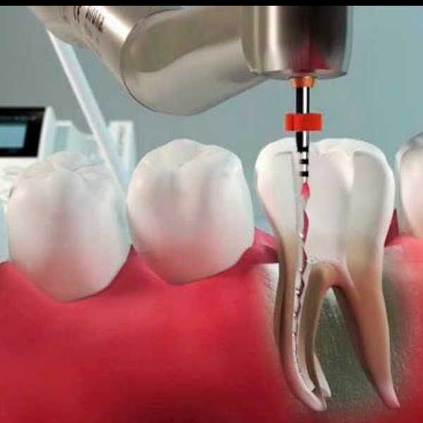 Hands on Endodontia: Sistemas rotatórios