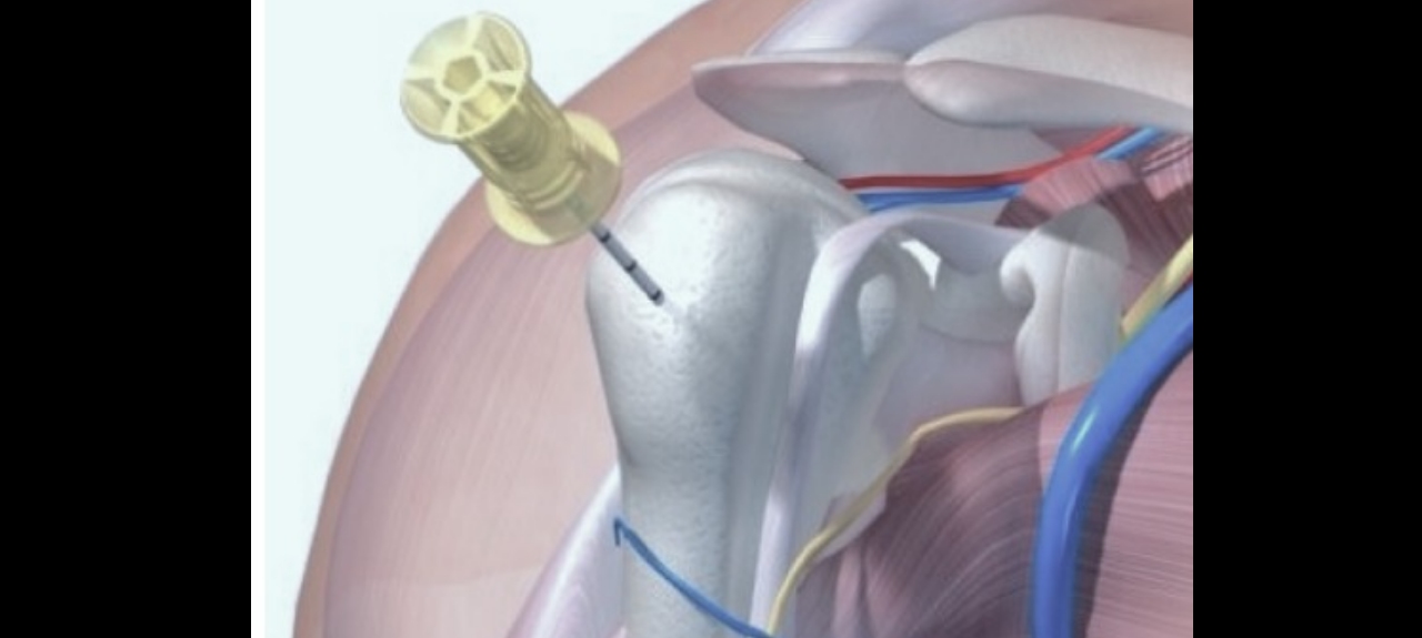 OFICINA DE ACESSO UMBILICAL E INTRAÓSSEA